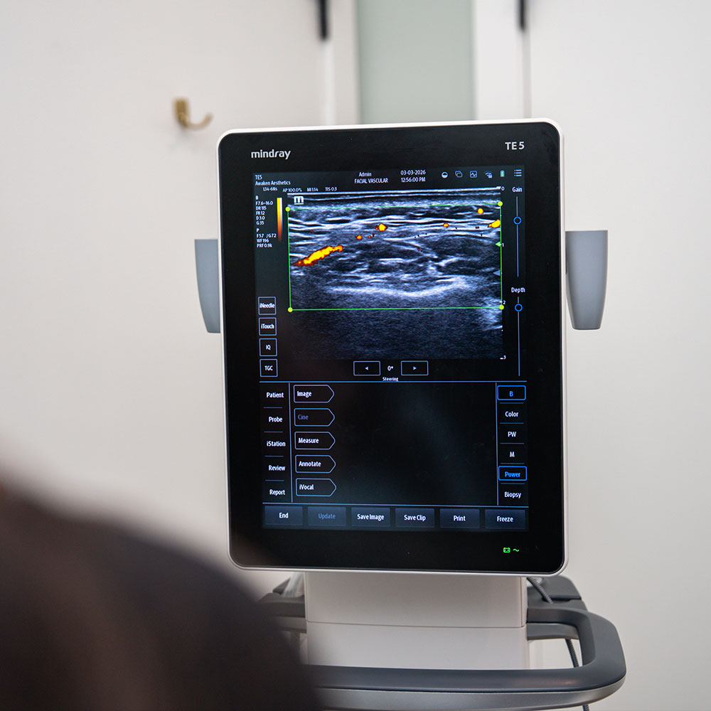 Ultrasound monitor displaying color Doppler vascular scan on a Mindray TE5 machine, with a person blurred in foreground.