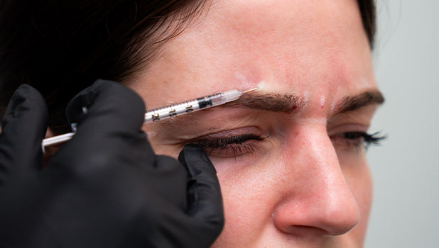 Close-up of a woman receiving a Botox injection between her eyebrows from a gloved practitioner