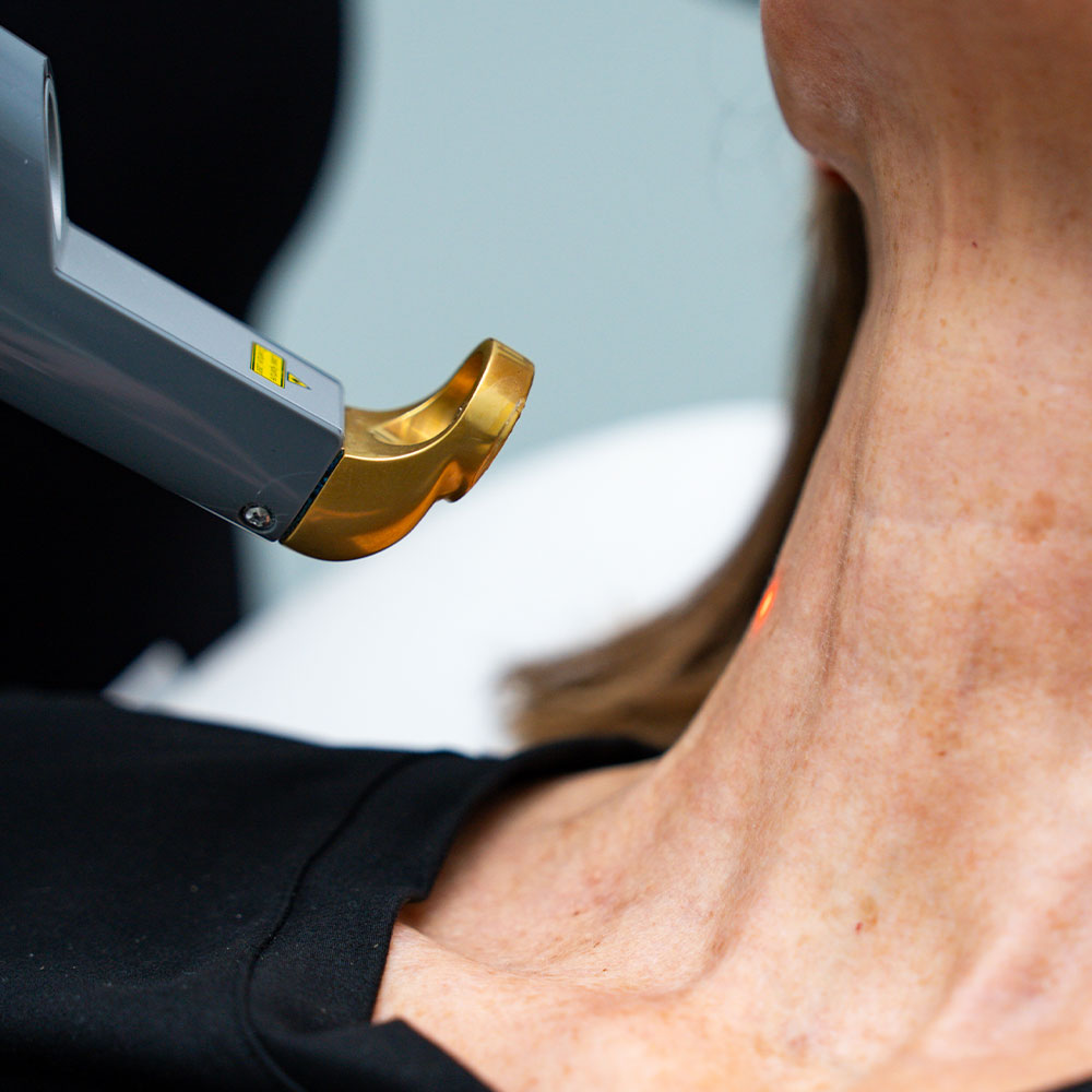 Close-up of a woman receiving laser skin treatment on her neck with a handheld gold-tipped device