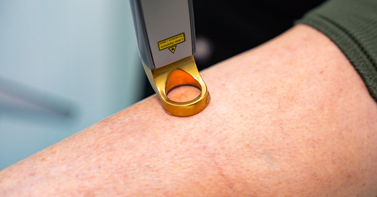 Close-up of a person's forearm receiving handheld laser skin treatment with gold-tipped device.