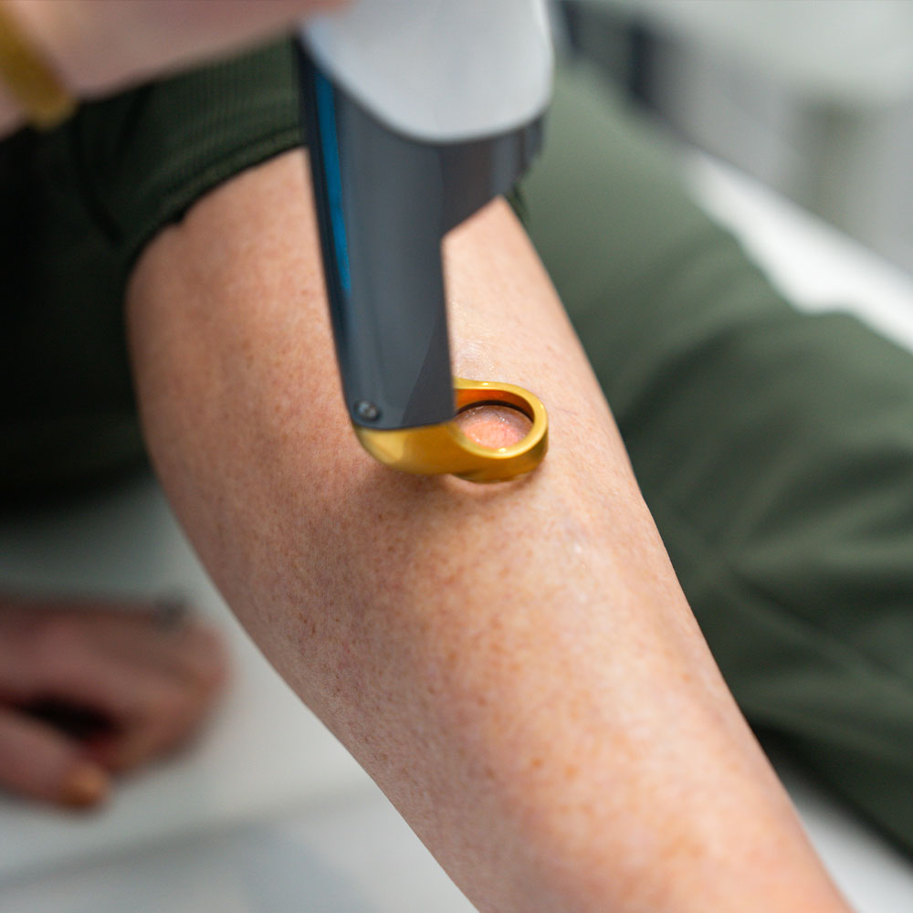 A person's forearm receiving handheld laser skin treatment with a gold-ring applicator