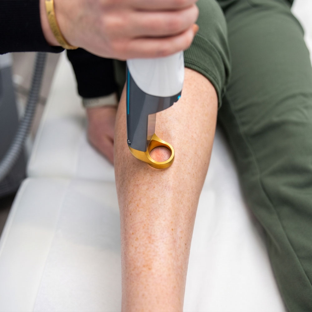 Handheld laser hair removal treatment on a person's lower leg with a gold applicator
