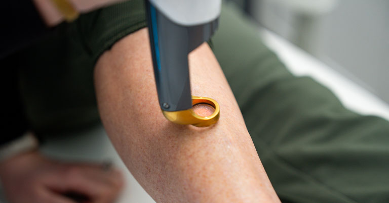 Person's forearm receiving handheld laser treatment with a gold ring applicator