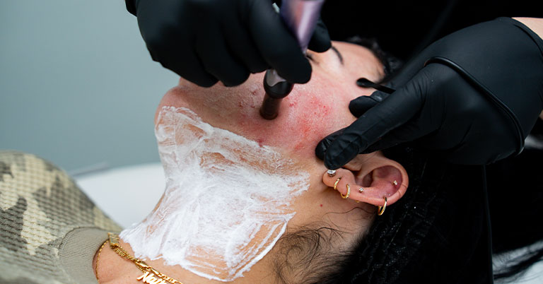 Woman receiving microneedling facial on chin and neck with numbing cream, technician wearing black gloves.