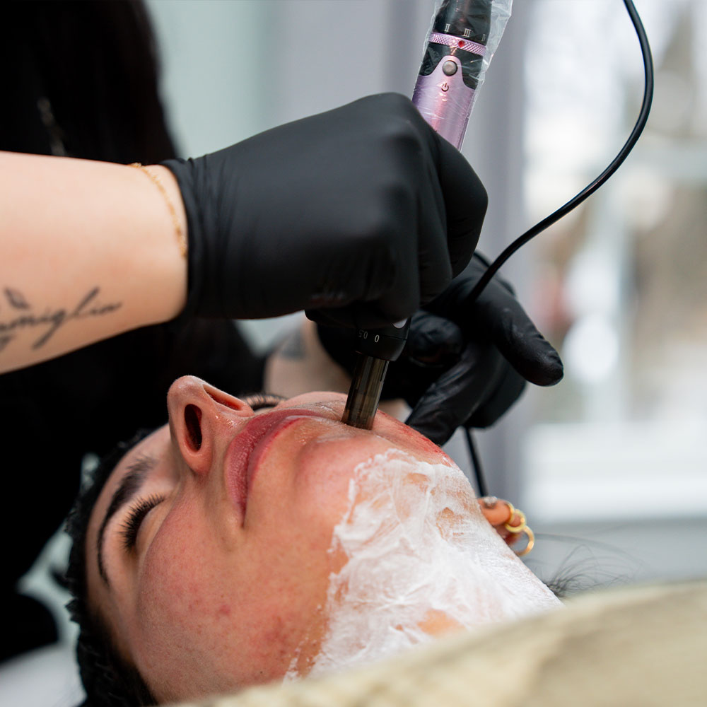Person receiving microneedling facial with a handheld device and white cream, technician wearing black gloves