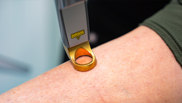 Close-up of a person's forearm during laser therapy with gold-ring applicator