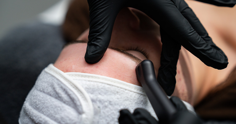 Close-up of a person receiving a facial treatment at the eyebrow with a handheld device and black-gloved hands.