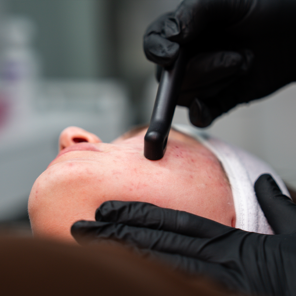 Acne facial treatment: esthetician uses handheld device on person's cheek, black gloves, visible blemishes